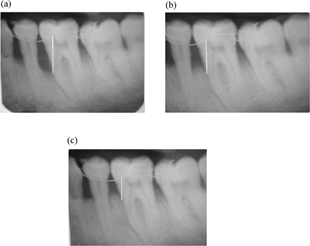 FIG. 3 (a) Radiograph film of the experimental site at the baseline shows the metal wire, taken as a standard landmark for all the measurements. (b) Radiograph film of the experimental site after 3 months. (c) Radiograph film of the experimental site after 6 months.