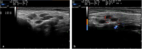Figure 3. (a) Grey-scale salivary gland ultrasonography (SGUS) image of Sjögren’s disease (SjD) patient with mucosa-associated lymphoid tissue (MALT) lymphoma of the right parotid gland. Characteristic for SjD are the hypoechoic areas and inhomogeneity of the tissue. (b) Color doppler (CD) ultrasound image of the same patient as in figure 3A. Diffuse vascular signals within the right parotid gland are observed.