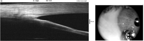 Figure 1 Anterior segment optical coherence tomography imaging. The picture shows a persisting irido-corneal contact despite central deepening of the anterior chamber during corneal indentation (synechial closure).