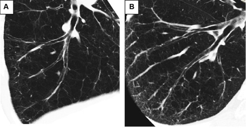 Figure 2 Two phenotypes of emphysema in relation to the numbers of airways and vessels.Notes: Two phenotypes of emphysema are shown. Right B9 bronchi were traced from entrance of segmental bronchi to the peripheral bronchi by curved multi-planar reconstruction images. Both cases had a similar percentage predicted diffusion capacity to carbon monoxide (%DLco: 56.5% versus 53.0%, respectively), but patient (A) has fewer lung structures around airways and patient (B) has more lung structures around airways. Case (A) had a lower %FEV1 value (62.9% versus 129.0%, respectively) and demonstrated a rapid annual decline in FEV1 (−104 mL per year versus −55 mL per year, respectively) compared to case (B).Abbreviation: FEV1, forced expiratory volume in 1 second.