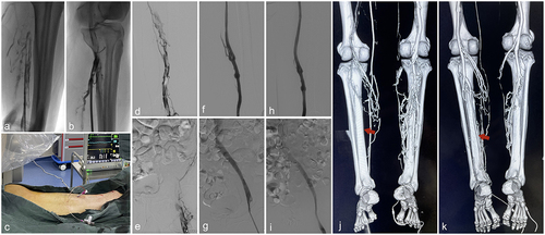 Figure 1. Surgical procedures and follow-up of patients with IFDVT. (a) the distal posterior tibial vein (DPTV) was punctured using a 21 G puncture needle, visualized by pushing contrast through the saphenous vein to the filling defect in the lumen at the point of thrombosis. (b&c) a 5 F vascular sheath was placed and then replaced by a 10 F vascular sheath. (d&e) the angiography showed extensive thrombosis in the iliac, femoral, and popliteal veins with blood flow obstruction. (f&g) After MAT, iliac vein PTA and stenting restored linear blood flow from the popliteal vein to the inferior vena cava, but residual thrombus was seen in the distal superficial femoral vein. A one-lumen 5 F CVC was placed for POT. (h&i) After 3 days of POT therapy, the repeated angiography showed an ideal restoration of blood flow without thrombosis in the iliac, femoral, and popliteal veins. (j&k) the CTV at 1 month after endovascular POT demonstrated good visualization of the popliteal vein and DPTV (red arrow mark) with restoration of blood flow in the lumen compared with the pre-operative condition.