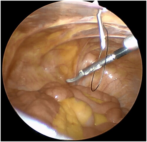 Figure 2. Veress needle sheath was inserted through the 5 mm incision. A forceps was used to assist the suture spread to form a ring.