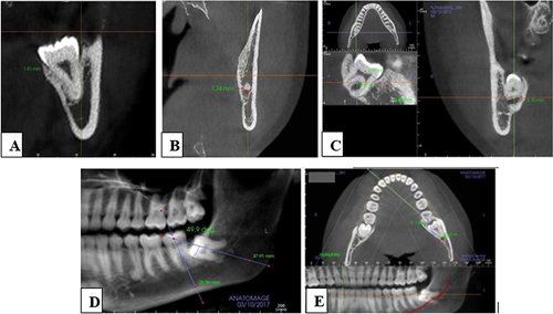 Figure 1 Showing various measurements on CBCT images. (A) Measurement of palatal bone thickness at cervical third root length. (B) Measurement of palatal bone thickness at apical third root length. (C) Measurement of palatal bone thickness at middle third root length. (D) Measurement of mesiodistal angulation. (E) Measurement of buccolingual angulation.