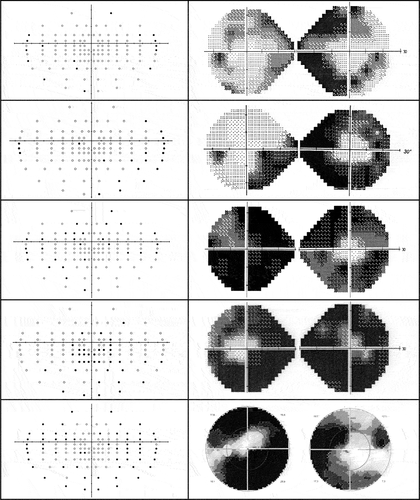Figure 2. Perimetric examinations with binocular Esterman (left) and 24-2 Humphrey or Octopus G-standard (right) for the five participants with visual field loss from optic disc drusen.