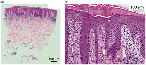 Figure 2. (a,b) Skin biopsy was performed from his right thumb in 2012. (HE staining).