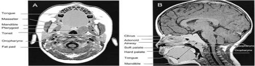 Figure S2 (A) Anatomical outlines of an axial T1 image at the level of the maximal tonsillar area of a control Subject. Transverse black arrow represents the intermandibular distance. (B) Anatomical outlines of a midsagittal T1 image of a control subject. Oblique black arrow represents the mental spine-clivus oblique distance.Note: Reprinted with permission of the American Thoracic Society. Copyright © 2020 American Thoracic Society. Arens R, McDonough JM, Costarino AT, Mahboubi S, Tayag-Kier CE, Maislin G, et al. 2001. Magnetic resonance imaging of the upper airway structure of children with obstructive sleep apnea syndrome. Am J Respir Crit Care Med. 4. 698–703. Official journal of the American Thoracic Society.Citation47