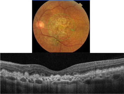 Figure 10 Fundus photograph (top) showing hard infiltrative drusen in the left eye of a patient with ARMD; the B-scan line on the fundus photograph has the same width as the B-scan SD-OCT image (bottom) which demonstrates the appearance of hard infiltrative drusen.