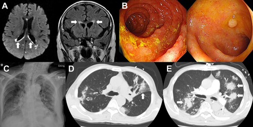 Figure 1. Infective complications of bendamustine-treated patients. (A). Patient 4 of the cytomegalovirus (CMV) disease cohort. Magnetic resonance imaging showed periventricular hyperintensities (arrows) indicative of ependymitis/ventriculitis. (B). Patient 5 of the CMV disease cohort. Upper endoscopy showing duodenal inflammation (left panel), and colonoscopy showing colitis (right panel). Histopathology of duodenal biopsy showed intranuclear CMV inclusion bodies, confirming CMV disease. (C). Patient 4 of the invasive fungal disease (IFD) cohort. Chest X ray showing bilateral consolidation. The patient was subsequently found to have cryptococcemia. (D). Patient 1 of the IFD cohort. Computed tomography (CT) scan of chest, showing wedge-shaped segmental lobar involvement (arrow) and consolidation (open arrow). Sputum grew Aspergillus niger. (E). Patient 3 of the IFD cohort. CT scan showed dense, well-circumscribed lesions (arrows). Bronchoalveolar aspirate grew Scedosporium apiospermum.