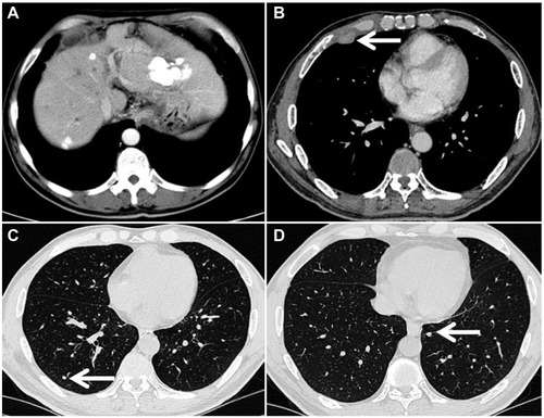 Figure 3 Computed tomography images of the chest and liver obtained from a 51-year-old male patient who had been treated with transarterial chemoembolization alone for 7 months. Although the intrahepatic lesions were controlled (A), there were right-sided pleural metastases (B, arrow shown) and bilateral lung metastases (C and D, arrow shown).