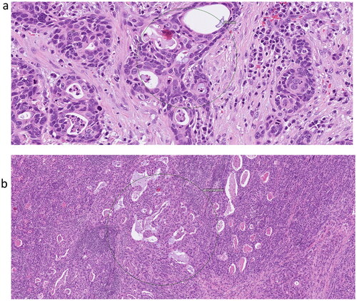 Figure 2. (a) Histological slide showing the mucoepidermoid carcinoma in the tonsil, hotspot within circle. (b) Histological slide showing metastasis of mucoepidermoid carcinoma in lymph node, hotspot within circle.