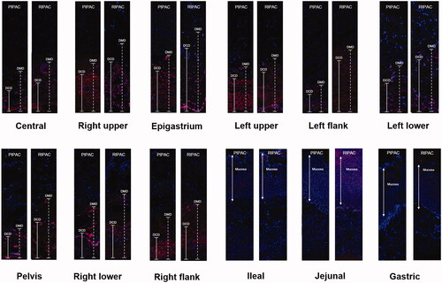 Figure 4. The depth of concentrated diffusion (DCD) and the depth of maximal diffusion (DMD) using confocal laser scanning microscopy in pressurized intraperitoneal aerosol chemotherapy (PIPAC) and rotational intraperitoneal pressurized aerosol chemotherapy (RIPAC) according to the modified Peritoneal Cancer Index.