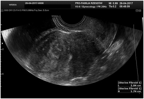 Figure 1. Transvaginal ultrasound scan 2 months before MR-HIFU procedure. Uterine fibroid in the anterior wall in direct contact with the endometrium.