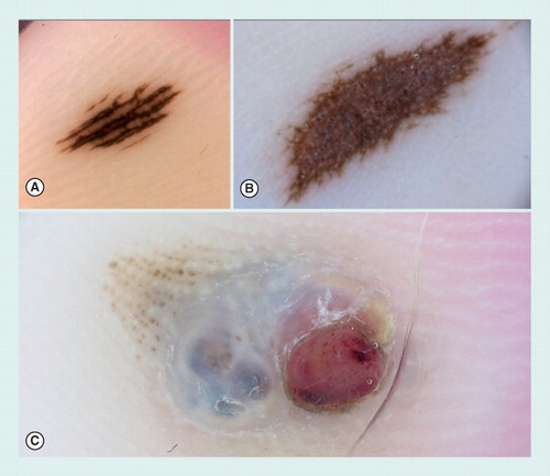 Figure 2. Dermoscopy images of three acral lesions.(A) A small acquired acral nevus showing a parallel furrow pattern. (B) Congenital acral nevus presenting a palpable area in the center of the lesion and displaying a grayish coloration by dermoscopy, corresponding to a dermal component of the nevus. At the periphery, a parallel furrow pattern can be detected. (C) Dermoscopy of an acral melanoma, arising on a pre-existing nevus. The melanoma was growing as a nodular component displaying a blue–white veil and an ulcerated red area.