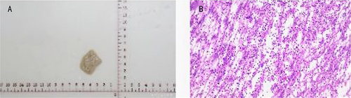 Figure 1 Histopathology of the brain abscess tissue specimen obtained from the mediastinal mass. Hematoxylin and eosin (H&E) staining showed extensive neutrophil cell infiltration. (A) Brain abscess tissue isolated during surgery. (B) H&E staining of brain abscess tissue.