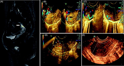 Figure 3. Retained placenta increta marked vascularity after delivery. (A) MRI showed the retained placenta increta as high signal intensity (arrow); (B) Ultrasound imaging before operation: 65 mm × 38 mm × 43 mm hyperechogenic shadow in the endometrial cavity with marked vascularity and deep myometrial invasion reached to uterine serosa was shown; (C) 25 mm × 20 mm × 23 mm hyperechogenic shadow at one month after operation; (D) 16 mm × 14 mm × 18 mm hyperechogenic shadow at three months after operation; (E) The lesion was not seen at six months after operation.