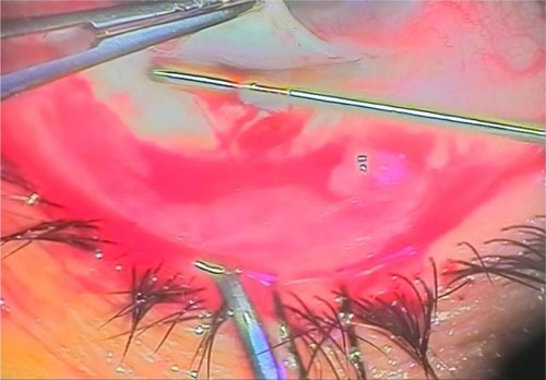 Figure 3 Passage of a metal probe through the anterior chamber.