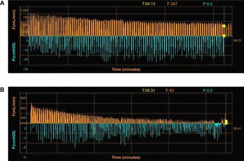 Figure 5 Assessment of collateral ventilation using Chartis system (Pulmonx Corp., Redwood City, CA, USA).