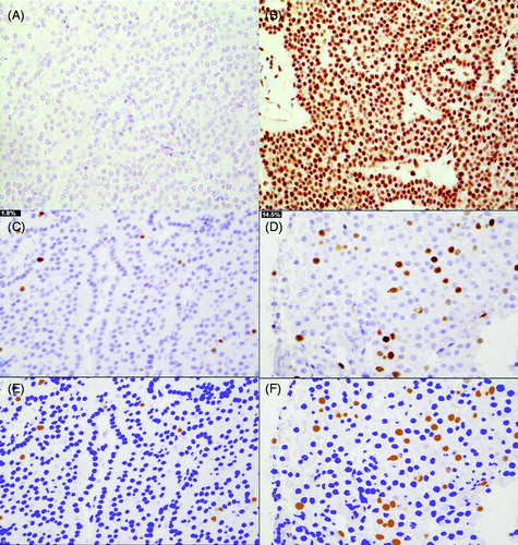 Figure 3. Parafibromin stain in parathyroid carcinomas (A negative and B positive). Digital images of Ki-67 staining in Tissue Micro Array in a parathyroid adenoma with a low PI (C) and in an aggressive parathyroid carcinoma with high PI (D). The corresponding pseudocolor image of Immunoratio-program respectively with low PI (E) and high PI (F).