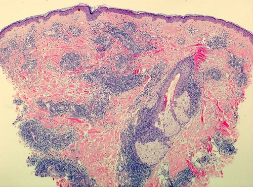 Figure 2 Histology of Lupus erythematosus tumidus: superficial and deep perivascular and periadnexal lymphocytic infiltrates with prominent mucinous dispositions and without epidermal changes.
