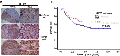 Figure 1 Higher expression levels of CIP2A in OSCCs. (A) Representative immunohistochemical expression patterns of CIP2A in nontumor tissues and OSCC specimens are shown. (B) Kaplan–Meier survival curves showing the difference of survival time between patients with low- and high-expression CIP2A on OSCC samples from 133 patients.Abbreviations: CIP2A, cancerous inhibitor of protein phosphatase 2A; OSCC, oral squamous cell carcinoma.