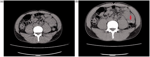 Figure 3. Axial non-contrast CT images of a 35-year-old body stuffer. With the low dose protocol (a), No definite pellets detected in abdomen secondary to increased image noise, however standard dose image (b) shows few small pellets in bowel loops in left abdomen (arrow).
