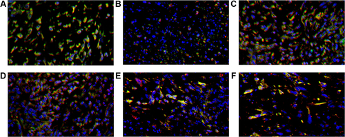 Figure 7 CD4+ TILs (red), PD-1+ TILs (green) and DAPI (blue) expression in tumor microenvironment of mice inoculated with breast cancer cells. (A) Inoculation of 4T1 cells. (B) Inoculation of 4T1 cells and metformin administration. (C) Inoculation of 4T1 cells with JNK knock-down. (D) Inoculation of 4T1 cells with JNK overexpression. (E) Inoculation of 4T1 cells with JNK knock-down and metformin administration. (F) Inoculation of 4T1 cells with JNK overexpression and metformin administration.