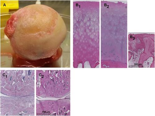 Figure 1 Osteoarthritic joint cartilage. (A) A femur head affected by OA explanted during joint replacement surgery is shown. Histological images (Hematoxylin Eosin staining) of (B1) nearly unaffected human cartilage, (B2 and B3) mild (hypocellularity, superficial clefts) and severely (cartilage absent, bone marrow activated, fibrosis) affected human joint cartilage. A histological image of healthy (C1) and severely osteoarthritic (C2) articular cartilage of the rat knee joint.