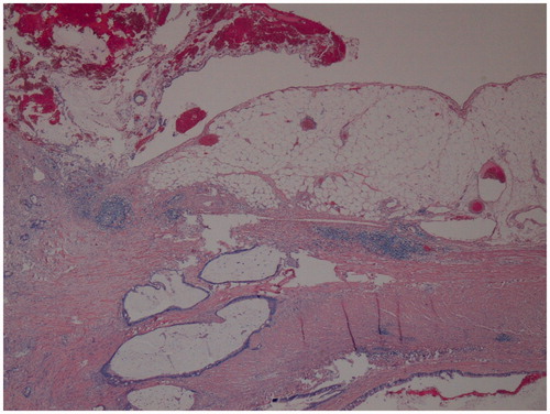 Figure 1. Pathological examination from the initial appendectomy performed in a 60-year-old woman, demonstrating mucinous adenocarcinoma with invasion of the appendiceal wall by gland-forming malignant cells and dissecting mucin (haematoxylin and eosin, original magnification ×40).