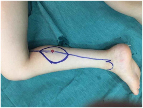 Figure 1. Position of the patient and location of the perforator