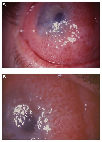 Figure 1 (A) Diffuse papillomatous lesion in bulbar conjunctiva covering part of the cornea of patient 1 and (B) In the papillomatous lesion of patient 1, repeating fibrovascular cores with geometrically arranged set of red dots are observed.