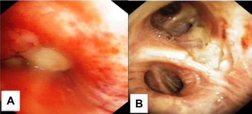 Figure 4 Patient 2 bronchoscopy findings upon diagnosis and after 10 weeks of therapy including four ITC-sessions and three reduced systemic carboplatin doublet applications.