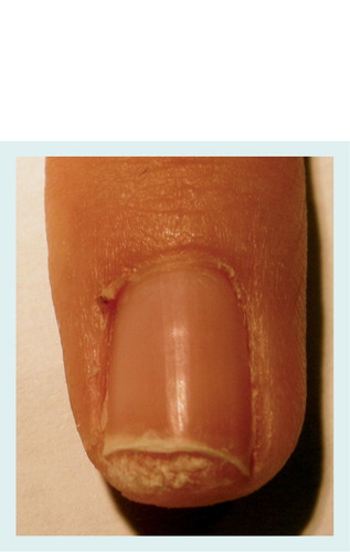 Figure 13. Subungual wart of the fifth right fingernail in a 7-year-old girl: subungual scales uplift and detach the distal nail plate and resemble distal subungual onychomycosis.