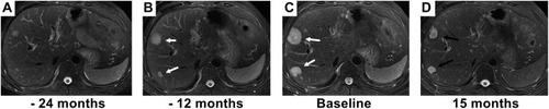Figure 2 The partial response to interferon-alpha 2b (IFN-a 2b) is illustrated in a male patient who experienced disease reoccurrence after surgery. (A) Small lesions were found 18 months after surgery. (B) Intrahepatic lesions (marked with white arrows) progressed after 12 months of observation. (C) Intrahepatic lesions (marked with white arrows) continued to progress after 24 months of observation, and IFN-a 2b was treatment started. (D) Fifteen months after initiation of IFN-a 2b treatment, the size of tumors decreased (marked with black arrows).