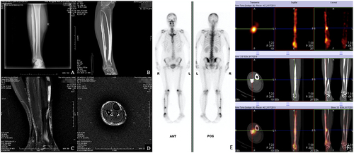 Figure 2 Imaging examination of SAPHO syndrome (A and B) X-ray and CT examination showed diffuse bone thickening in the upper and lower segments of the right fibula. (C and D) MRI examination suggested limited bone marrow edema in the right fibula; (E and F) 99mTc-MDP whole-body bone scintigraphy showed abnormal radioactive concentrations on the right fibula, and fusion tomography demonstrated thickening of the bone cortex.