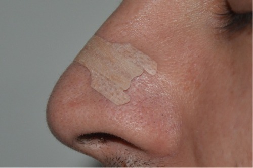 Figure 3 Side view of the external nasal dilator application site.