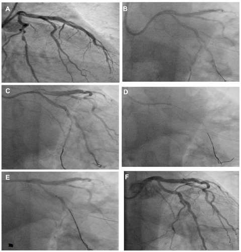 Figure 11 XB catheter for left anterior descending artery changed to an Amplatz left 2 catheter for proper support of percutaneous coronary intervention to the obtuse marginal artery.