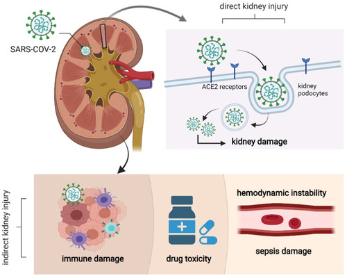 Figure 3 The possible mechanism of kidney injury in COVID-19 patients: SARS-CoV-2 enters kidney cells through human angiotensin converting enzyme 2(ACE2), resulting in degeneration and necrosis of kidney cells. Immune injury, sepsis-related kidney injury, hypovolemic renal hypoperfusion and drug-related kidney injury are all possible mechanisms of kidney injury.