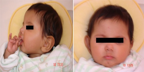 Figure 3 Facial features of a 1-year-old girl with Sanjad–Sakati syndrome.