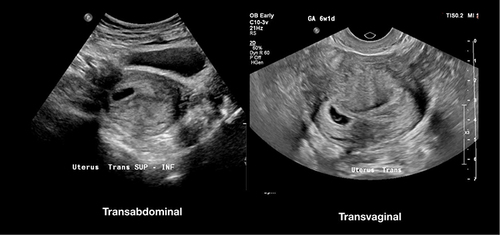 Figure 2 Transabdominal and transvaginal image of one study wherein the two ED physicians disagreed about the presence or absence of an intrauterine pregnancy on transabdominal imaging.