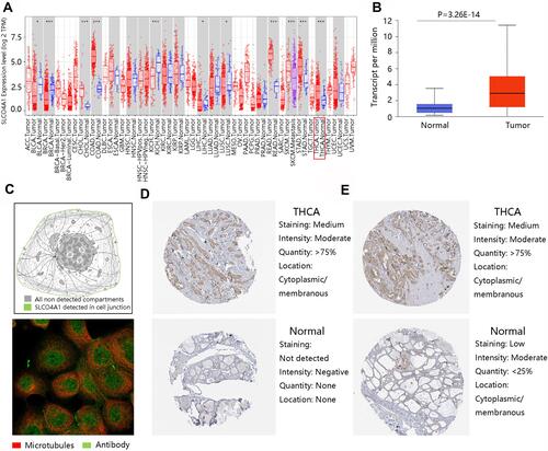 Figure 2 Overexpression of SLCO4A1 in thyroid cancer. (A) The gene expression level of SLCO4A1 in multiple types of tumor and normal tissues in TIMER. Red box indicated thyroid cancer. (B) SLCO4A1 gene expression in normal and thyroid cancer via UALCAN database. (C) The localization of SLCO4A1 protein in tumor cells and immunofluorescence staining in the A-431 cell line. (D and E) The protein expression of SLCO4A1 in thyroid cancer and normal tissues. *P <0.05, ***P <0.001.