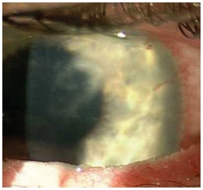 Figure 1 Multiple corneal infiltrates of the left cornea.