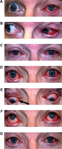 Figure 1 Clinical presentation of bilateral ocular CA24v infection.