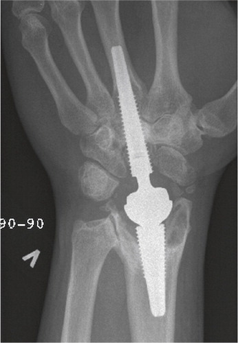 Figure 39. Focal periarticular radial osteolysis filling out the radial styloid at 3 years. Sclerotic line limiting the non-progressing lesion. Excellent clinical outcome.