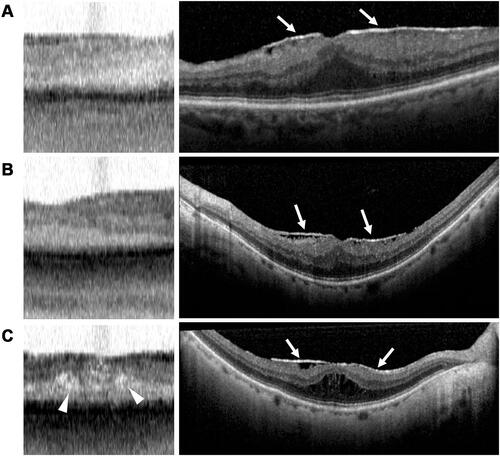 Figure 2 Epiretinal membrane appearance on swept-source OCT and spectral-domain OCT. (A–C, left) IOLMaster 700 SS-OCT scans of three different eyes with epiretinal membranes, demonstrating foveal thickening and intraretinal cystic spaces (arrowheads). (A–C, right) Corresponding Spectralis SD-OCT scans of epiretinal membranes (arrows) for comparison.