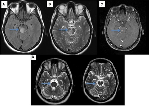Figure 2 (A, B) Axial FLAIR-T2 images reveal hyperintense lesion in the brainstem (arrow), (C) axial T1 gadolinium sequence shows gadolinium enhancement (arrow) and (D) prominent brainstem atrophy (arrow) on the follow-up MRI after 3 years.