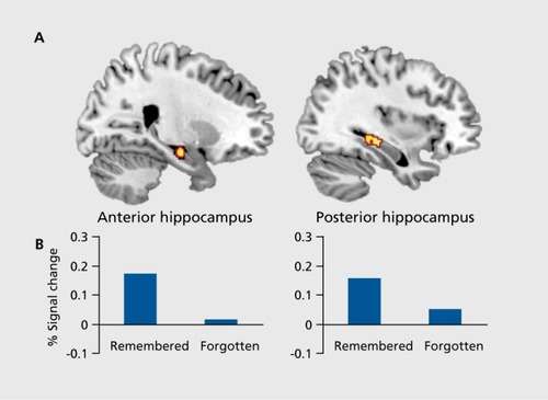 Figure 2. Hippocampal responses to encoding. In the same study described in Figure 1, Citation87 approximately 10 minutes after imagining future events comprised of person, place, and object details, participants were given a cued recall test in which two details from the simulation were provided, and they were asked to recall the third detail. A subsequent memory analysis revealed clusters in anterior and posterior right hippocampus that showed significantly greater activity during encoding for those simulations in which details were subsequently remembered vs those in which details were subsequently forgotten. Adapted from ref 87: Martin VC, Schacter DL, Corballis MC, Addis DR. A role for the hippocampus in encoding simulations of future events. Proc Natl Acad Sci U S A. 2011;108:13858-13863. Copyright© National Academy of Sciences 2011.