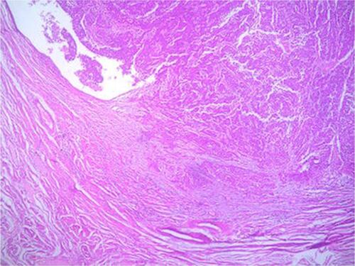 Figure S2 High-grade serous tubal carcinoma arises from tubal mucosa and infiltrates the submucosa (H&E ×10).