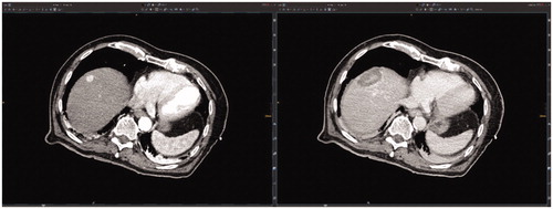 Figure 1. Evaluation of the technical success and technique efficacy after stereotactic radiofrequency ablation (SRFA) through conventional side-by-side juxtaposition of pre- and post-interventional CT-scans as shown to the participants of the so-called ‘ablation assessment quiz’.
