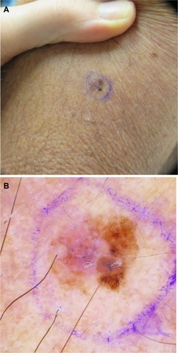Figure 1 (A) Clinical image of a pink and brown macule of the left upper arm, diagnosed as a stage IA superficial spreading melanoma, with Breslow depth of 0.28 mm. (B) Dermoscopy demonstrates a globally asymmetrical lesion, with a disorganized reticular network on the right and a milky/pink homogenous area on the left.