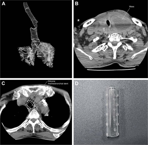 Figure 2 (A) Three-dimensional computed tomography (CT) scan showed the narrowest part of the trachea present beneath the sternum. (B) Axial CT scan was done. A mass can be seen on the right side of the trachea, and due to the mass the trachea is deviated to the left side, compromising the airway tract before placement of the tracheobronchial stent. (C) After the placement of the tracheobronchial stent, the airway was recovered. (D) Dumon Silicone stent.